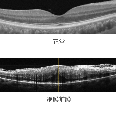 正常な網膜と黄斑上膜（網膜前膜）