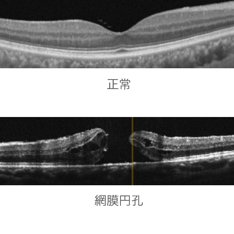 正常な網膜と黄斑円孔