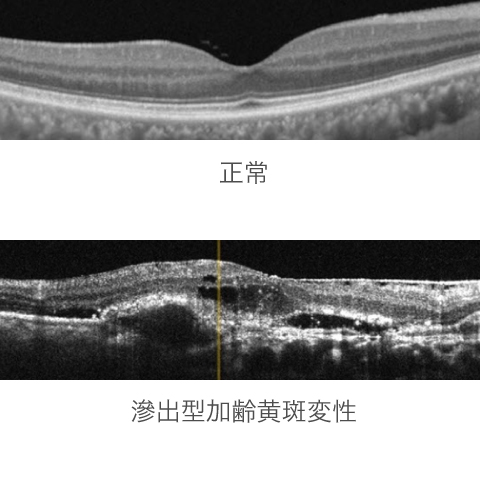 正常な網膜と（滲出型）加齢黄斑変性