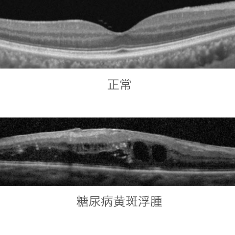 正常な網膜と糖尿病網膜症