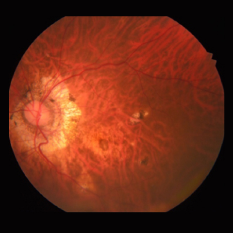 近視性脈絡膜新生血管