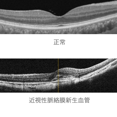 正常な網膜と近視性脈絡膜新生血管